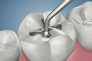 Amalgam Filling (Top View)